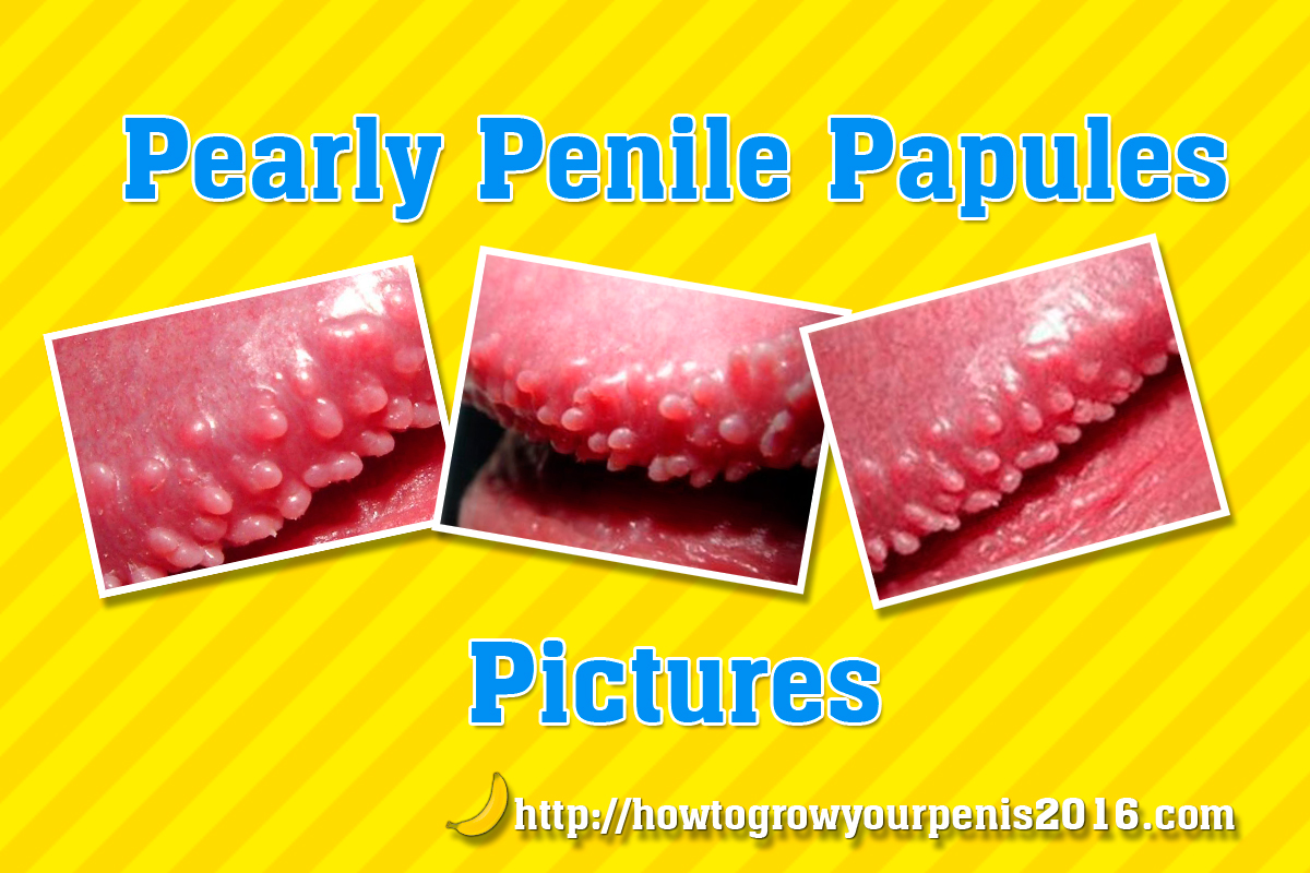 pearly penile papules pictures